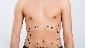 Can Tummy Tuck in Islamabad Be Customized for Male Patients?